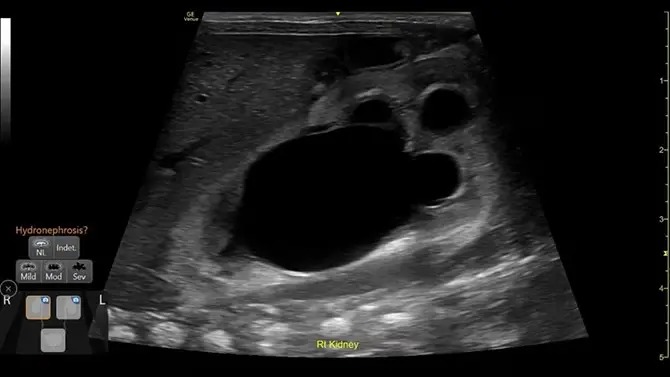 Renal Diagram providing easy follow up for suspected hydronephrosis, Rt Kidney