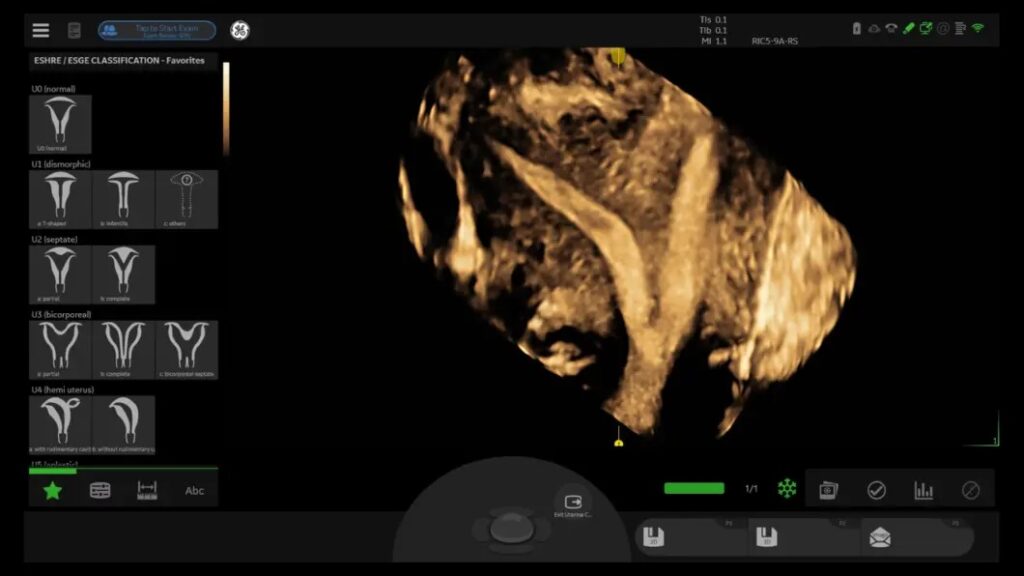 Septate Uterus with Eshre