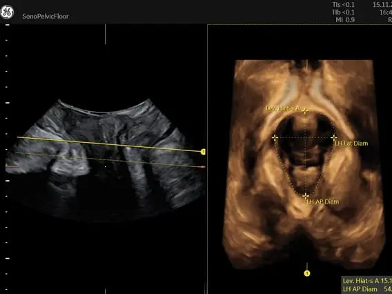 Sono Pelvic Floor