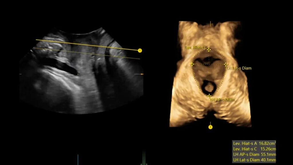 Sono Pelvic Floor
