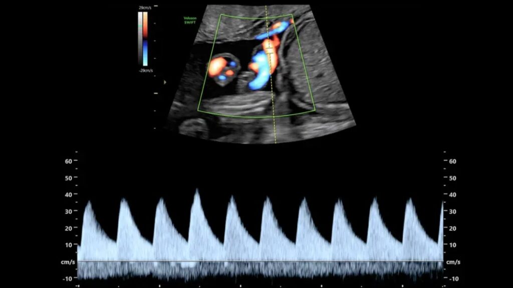 Umbilical Doppler