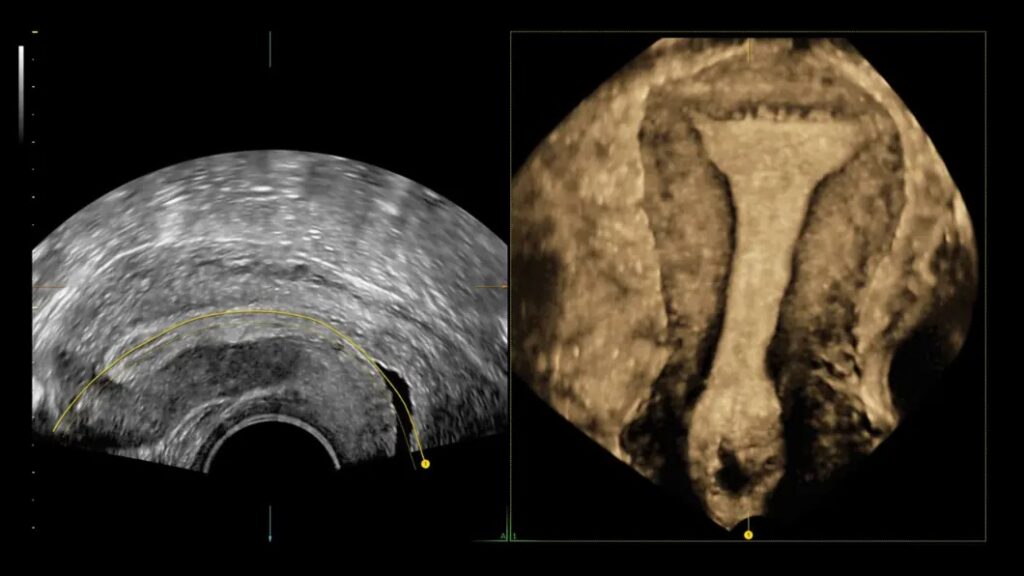 Uterin Trace