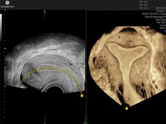 Uterine