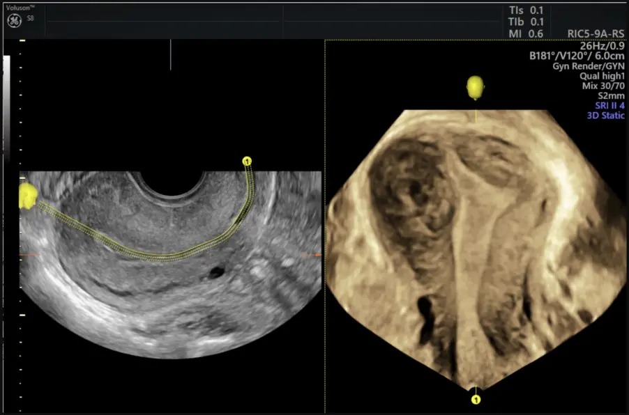 Uterine Trace Image