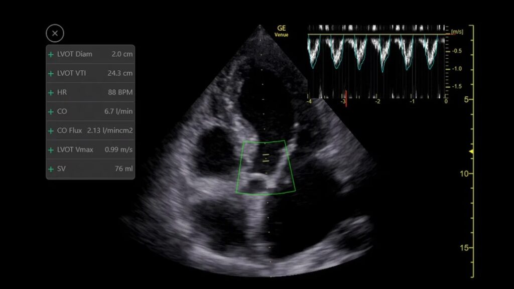 Auto VTI, Cardiac Output (CO), A5CH, 3Sc