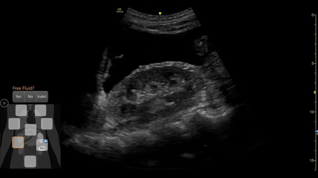 eFastscan, from internal bleeding to pneumothorax
