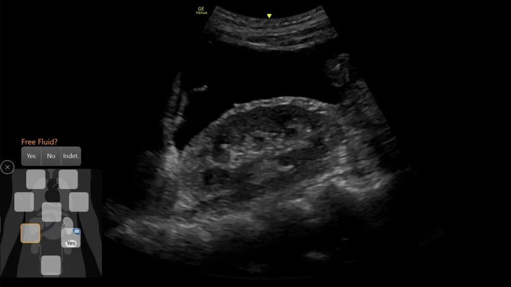 eFastscan, from internal bleeding to pneumothorax