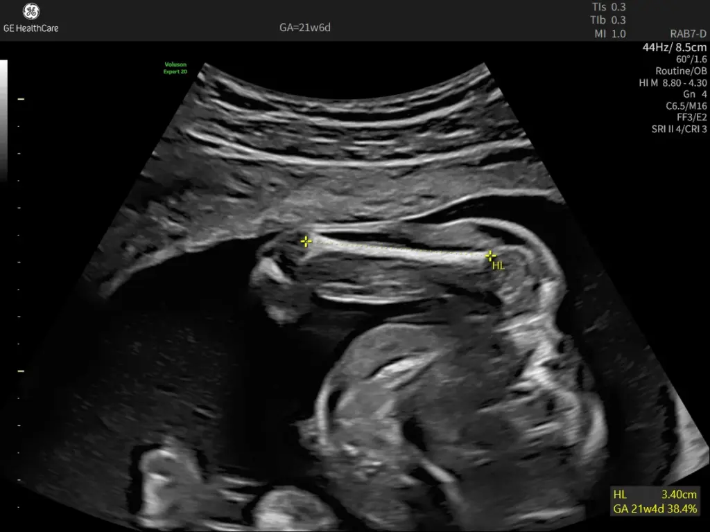 Humerus length measured with Sonobiometry