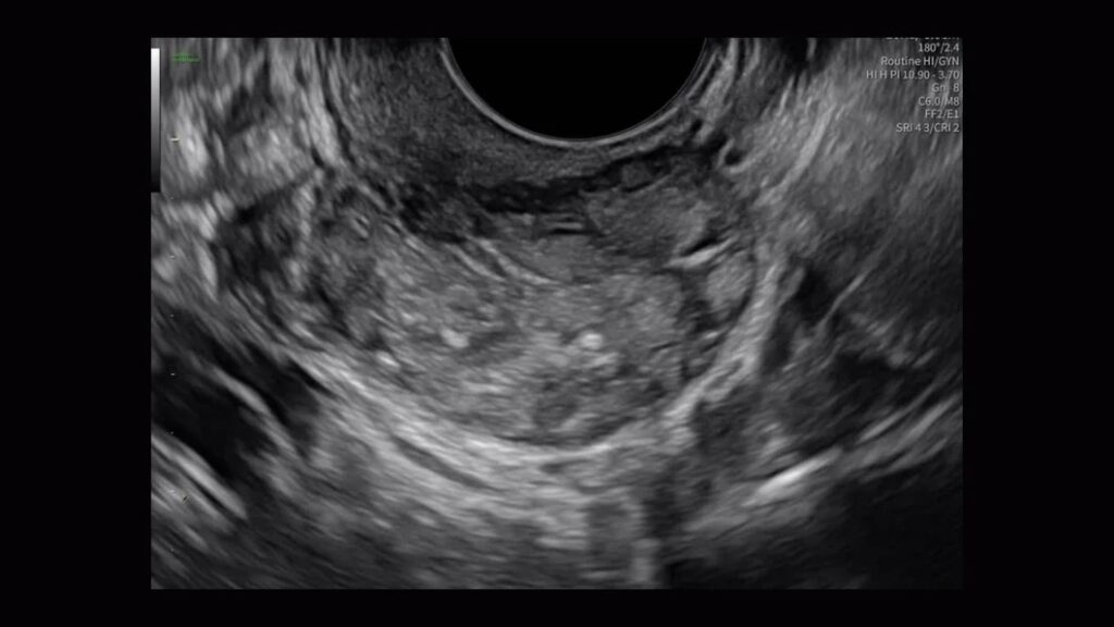 Ovarian Mass