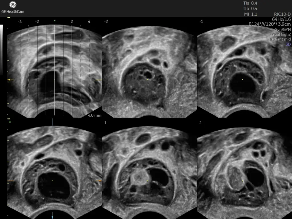 Ovarian mass
