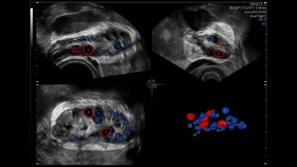 SonoAVC Antral