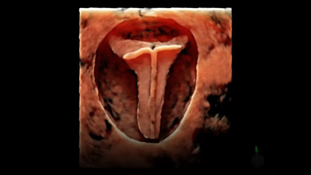 Uterus IUD