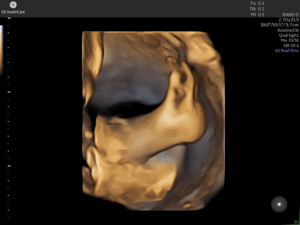 Fetal legs and feet