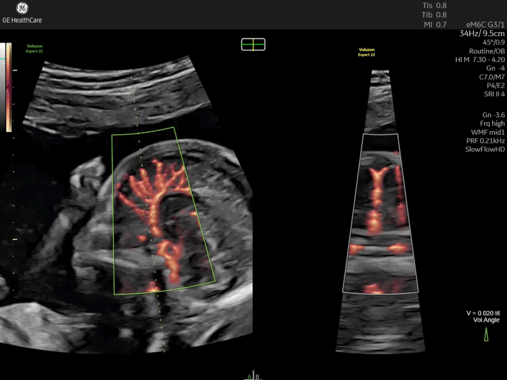 Fetal brain with SlowflowHD