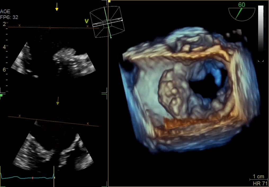 Adult Vmax Mitral Valve Barlow - Single Beat 32fps