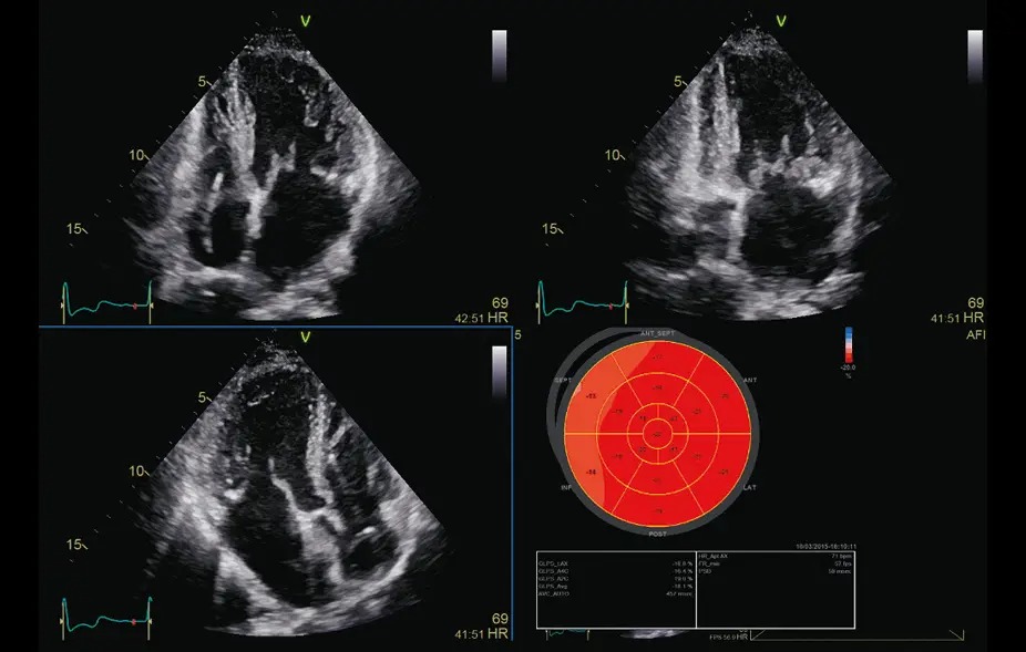 AFI 3.0 Including Ejection Fraction