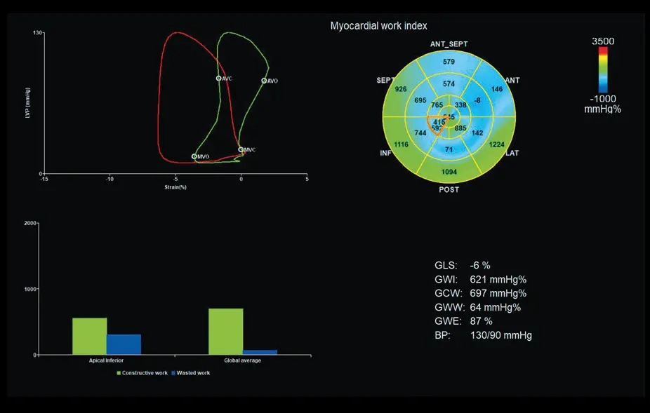 Myocardial Work