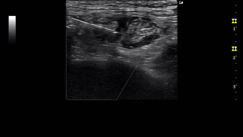 Needle Recognition